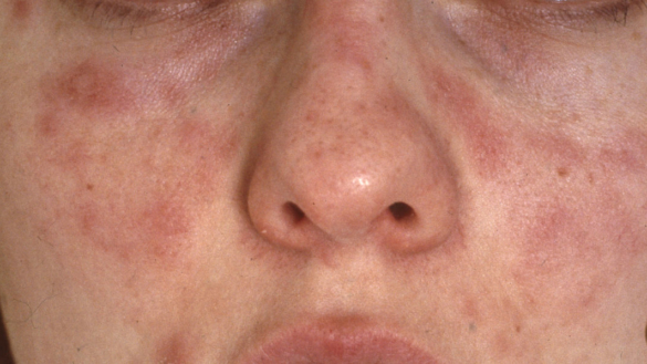 Soleksem og lysfølsomhed