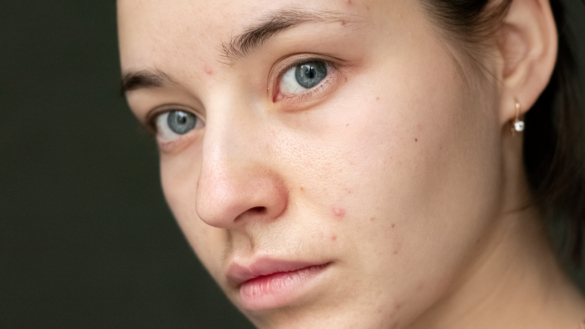 Perioral dermatitis (eksem rundt om munden) årsager og behandling