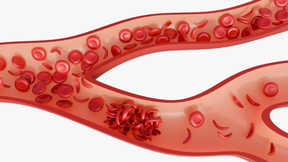 Seglcelleanæmi (SCD) – symptomer, årsager og behandling
