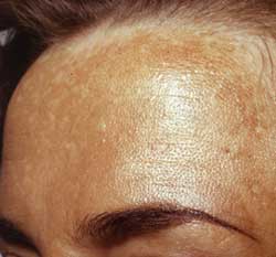 Melasma (øget pigmentering) årsager og behandling af brune pletter