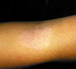 Pityriasis alba. Behandling