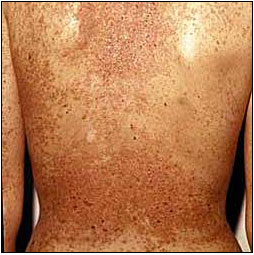 Ved Dariers sygdom, som er en arvelig og kronisk hudsygdom, opstår der en masse små og fedtede papler. Typisk forekommer udslættet hen over brystet og på ryggen.