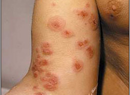 Erythema Multiforme. udslæt.