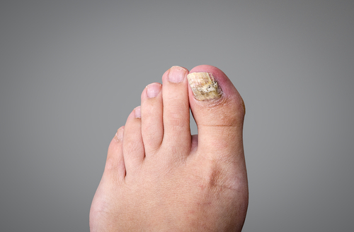 Neglesvamp. Hvad er det og hvordan skal jeg behandle det