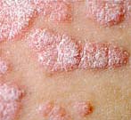 Psoriasis, psoriasisgigt, diagnose og behandling