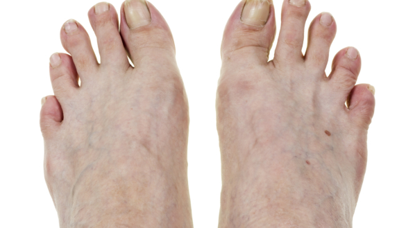 Hammertå (klotå) Behandling