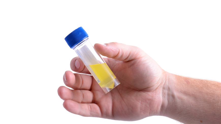 Der findes mange årsager til at man har blod i urinen, eksempelvis urinvejsinfektion eller nyresten.