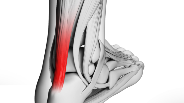 Akillesseneruptur. Årsager og behandling