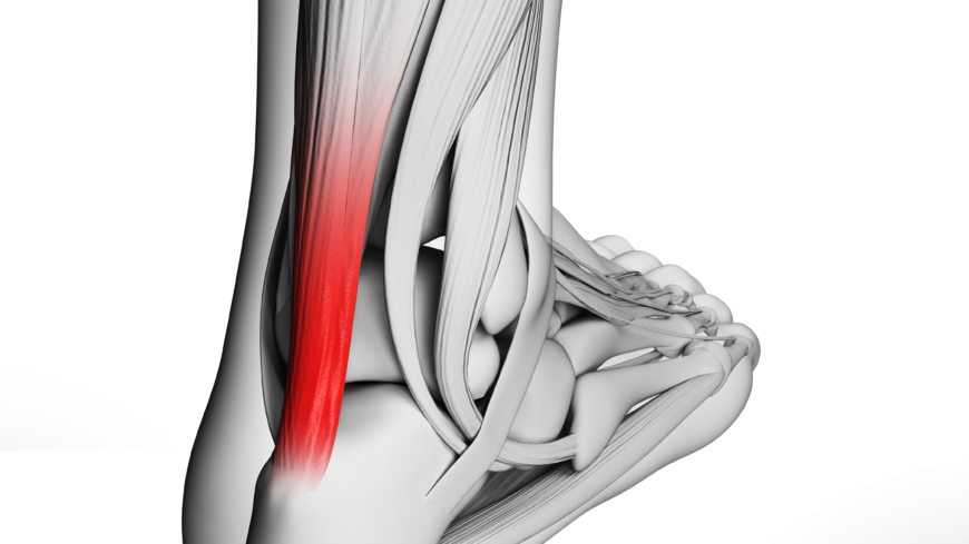 En akillesseneruptur indebærer, at akillessenen bliver revet over, hvilket ofte sker under sportsudøvelse