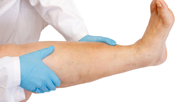 Åreknuder (varicer) Behandlingsmuligheder