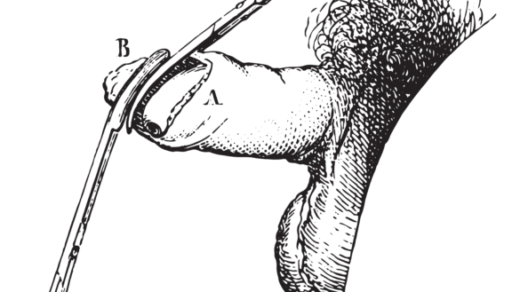 Forhudsforsnævring (fimosis) alder, årsag og behandling