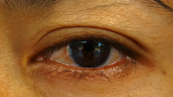 Keglehornhinde (Keratoconus) hvad er det, og hvordan behandles det.