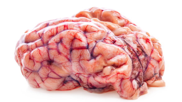 Slagtilfælde – hjerneblødning eller blodprop? (Apopleksi)