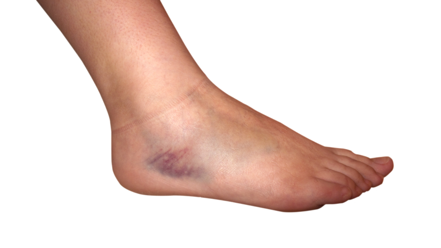 Hvis man forstuver sin fod, så betyder det, at vævet i anklen er skadet.  Foto: Shutterstock