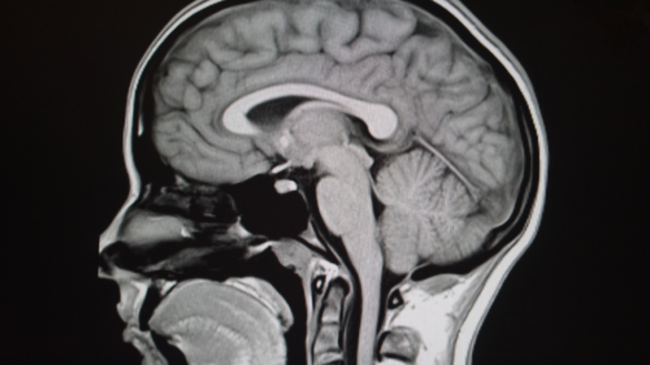 Hjernehindebetændelse (meningitis). Årsager, symptomer og behandling