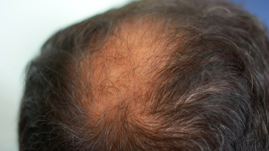 Mandlig skaldethed (androgen alopeci) arvelighed og behandlingsmuligheder