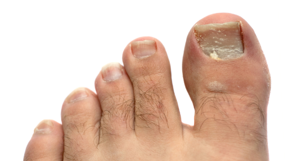 Hallux Valgus / skæv storetå. Hvad er det og skal det behandles?