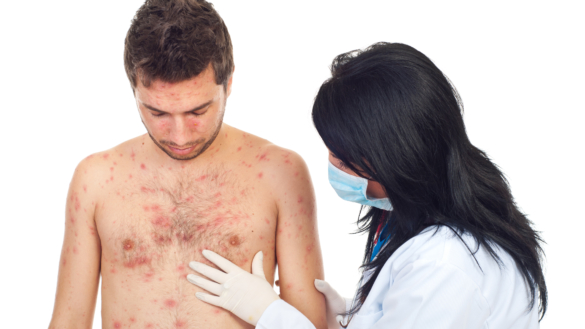 Fransk rosen (pityriasis rosea)