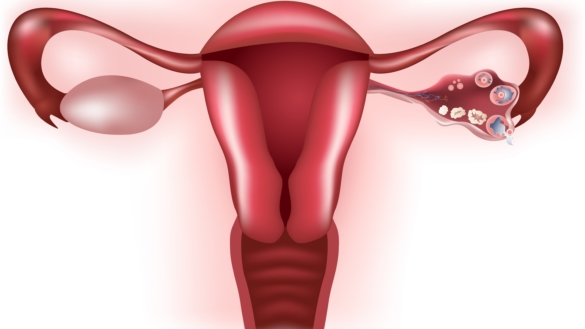 Fibromer i Uterus (muskelknuder) Smerter, graviditet, behandling