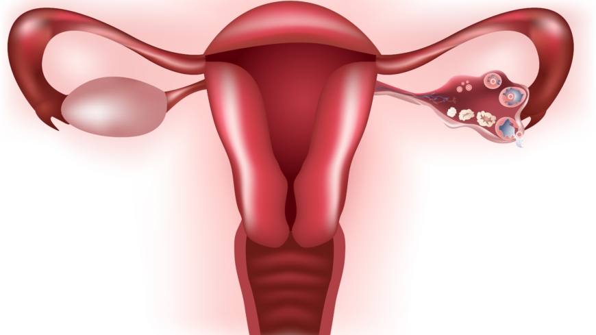 Fibromer i uterus er knuder på livmoderen og forekommer oftest hos kvinder i alderen 35-45 år. Foto: Shutterstock