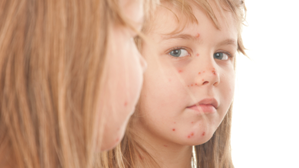 Ringorm (tinea corporis) diagnose og behandling